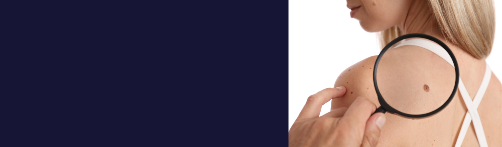 De Belg is een slechte leerling op het gebied van uv-bescherming